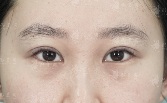 西安双眼皮修复谁做得好?孙峰/叶桐江/宋蔚等医生实力盘点