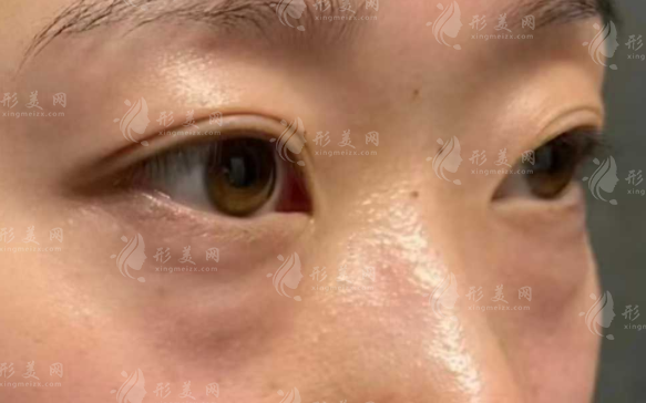 重庆去眼袋哪家好？华美/军美/米兰柏羽/艺星等六强盘点