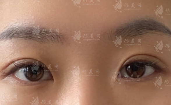董瑞芳眼修复技术好吗?2026价格+口碑全揭秘