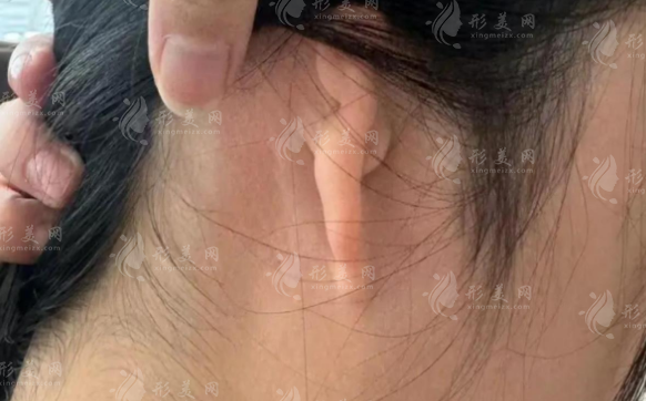 上海东方丽人吴建明耳畸形团队靠谱吗?技术费用人群全解析