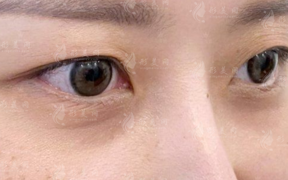 眼袋泪沟黑眼圈怎么区分?辨别方法与改善方案全攻略