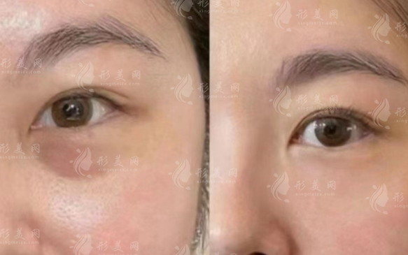 黄石无痕去眼袋效果好吗?价格多少?适合哪些人?