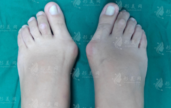 乌鲁木齐大脚骨手术哪家好?青松星范伊丽莎白华美排名揭秘 乌鲁木齐大脚骨手术哪家好?青松星范伊丽莎白华美排名揭秘