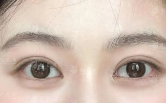 武汉做双眼皮哪家医院好?前十正规机构技术特点盘点 武汉做双眼皮哪家医院好?前十正规机构技术特点盘点