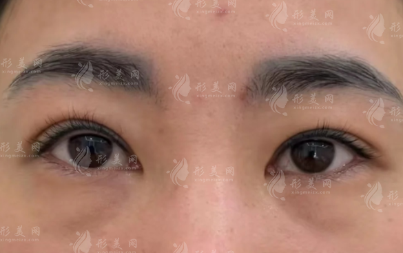 咸阳做眼袋手术哪家好?三家正规机构排名推荐 咸阳做眼袋手术哪家好?三家正规机构排名推荐