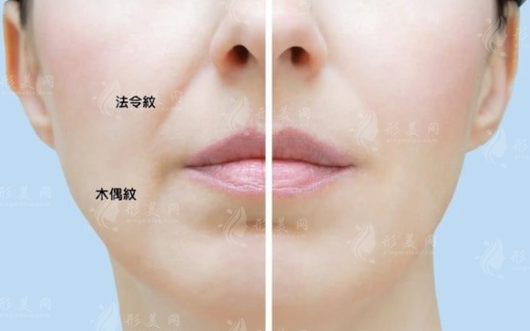 法令纹明显该填玻尿酸还是做提拉?一文看懂怎么选 法令纹明显该填玻尿酸还是做提拉?一文看懂怎么选