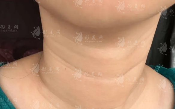 颈纹怎么消除?日常护理+医美方法全攻略
