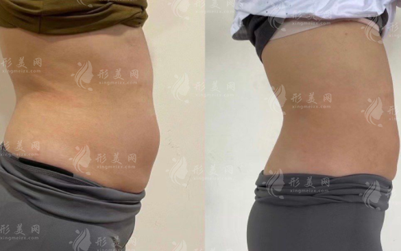 玲珑体雕能塑形吗?效果分析+适合人群一文说清