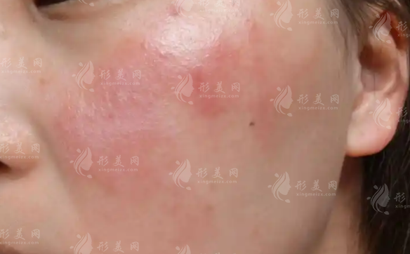 敏感肌屏障受损怎么修复?急救攻略+护肤指南