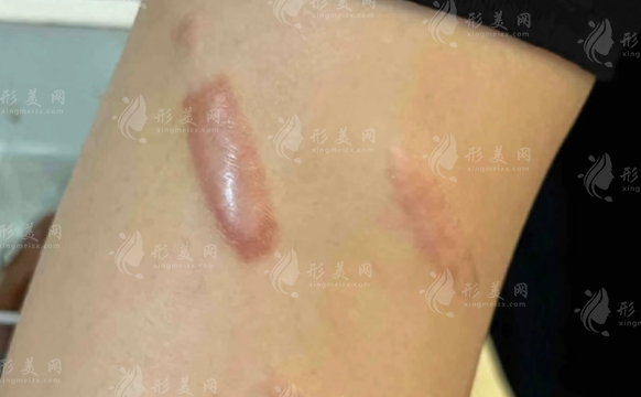 沈阳华美疤痕修复中心靠谱吗?技术+价格+口碑全解析 沈阳华美疤痕修复中心靠谱吗?技术+价格+口碑全解析