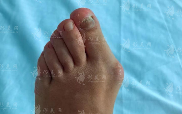 温建民拇外翻手术靠谱吗?微创技术+费用+适合人群详解