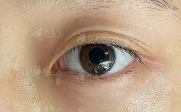 杨胤恒修复馒化口碑如何?术后灵动自然不僵硬!