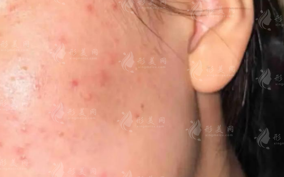 油痘肌救星!超光子联合黄金微针，皮肤"水泥封层"新方案实测