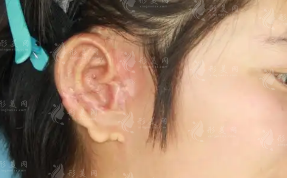 郑州耳再造哪家好? 当地人力推郑州整形美容医院+张正文