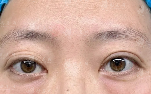 眼袋手术后会复发吗?术后护理+预防攻略一次说清