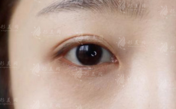 上海眼修复医生排名前三?杨洪波高难度修复技术揭秘