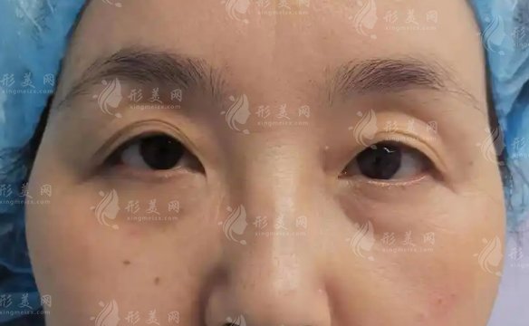 北京田永成切眼袋多少钱?2026年价格表+避坑指南 北京田永成切眼袋多少钱?2026年价格表+避坑指南