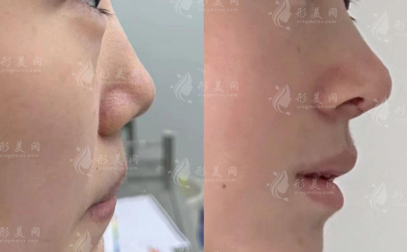 深圳鸿瑞医疗张辉坐诊!赫本鼻+鼻修复价格全公开 深圳鸿瑞医疗张辉坐诊!赫本鼻+鼻修复价格全公开