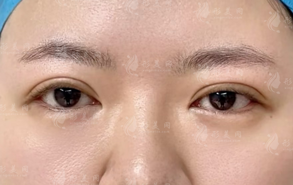 北京双眼皮修复医生推荐:晶美魏志香技术口碑全解析
