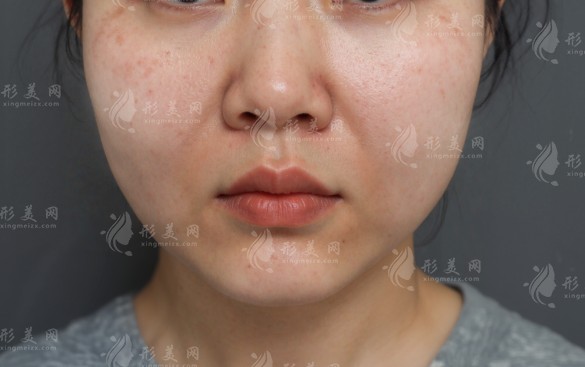 馒化脸修复多少钱?北上杭成价格+靠谱医院医生盘点