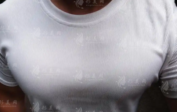 男性胸部整形哪里好?北京美莱广州美莱技术解析