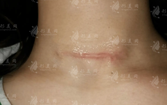 沈阳华美疤痕医院靠谱吗?祛疤技术硬核价格透明!