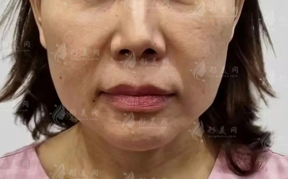 40岁脸下垂像发面馒头?筋膜提升vs线雕怎么选!