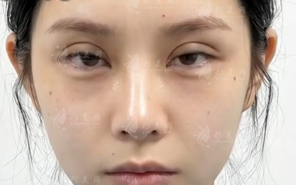 无锡双眼皮修复找欧阳黎平靠谱吗?技术价格全解析