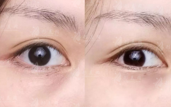 郑州双眼皮医生排名前十!张芳申丽等十位技术大比拼