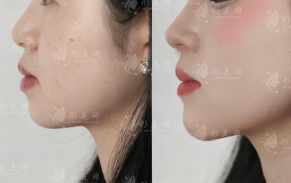 北京冯雁平隆鼻口碑怎么样?妈生鼻技术好价格透明
