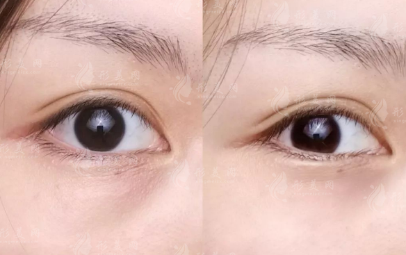 北京眼修复哪家好?晶美魏志香院长双眼皮修复价格表及攻略全解析 北京眼修复哪家好?晶美魏志香院长双眼皮修复价格表及攻略全解析
