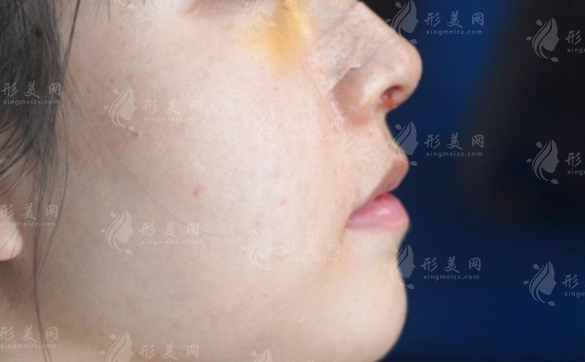 隆鼻失败怎么办?鼻修复前这3件事必须搞清楚!