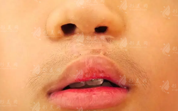 毛喆医生做唇裂修复好吗?技术优势+适合人群全揭秘!