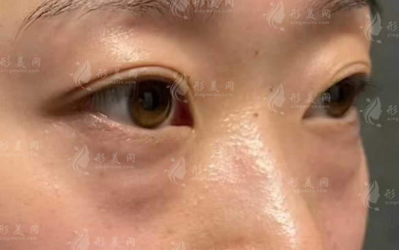 深圳祛眼袋医院哪家好?这五家正规机构口碑实力双在线