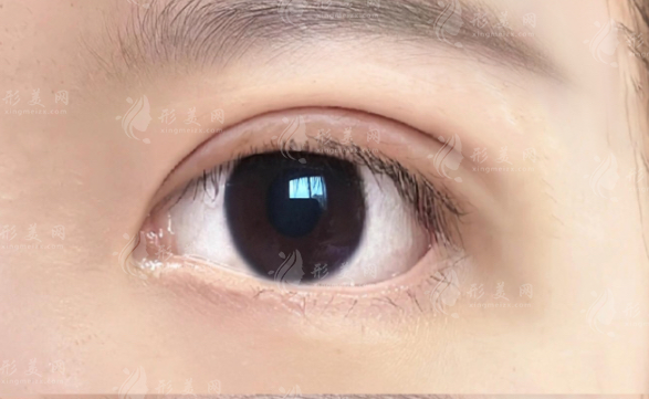 深圳秦王驰双眼皮技术好吗?妈生感风格+价格全解析