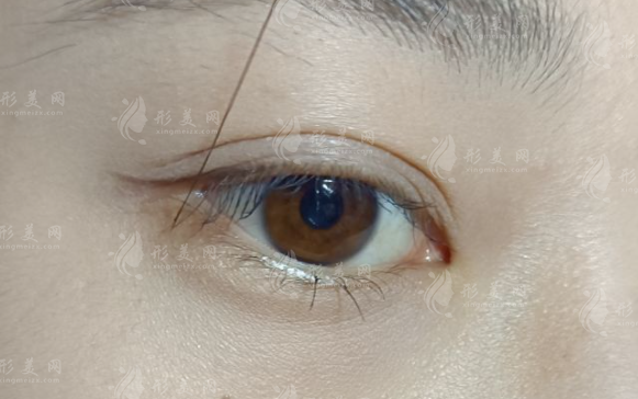 双眼皮割多宽才自然?1mm决定妈生感还是悲伤蛙 双眼皮割多宽才自然?1mm决定妈生感还是悲伤蛙