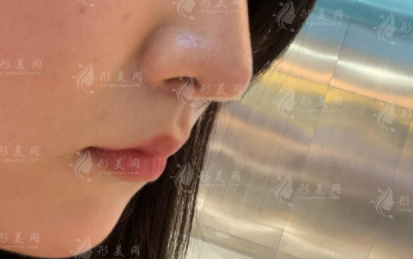 谭拯人中缩短手术怎么样?技术价格全解析,看完再决定 谭拯人中缩短手术怎么样?技术价格全解析,看完再决定