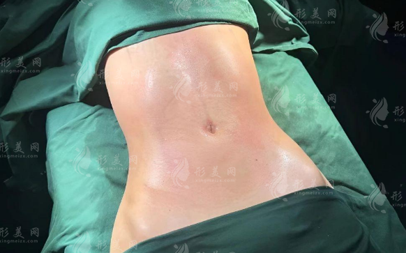 吸脂后皮肤会松弛下垂吗?多久能练出小蛮腰?