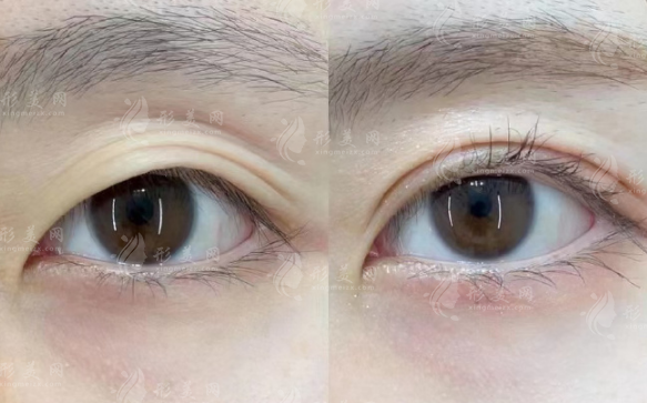 郑永生双眼皮修复技术好吗?口碑评价及价格全解析 郑永生双眼皮修复技术好吗?口碑评价及价格全解析
