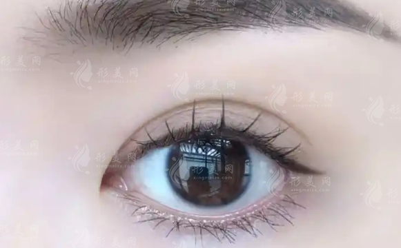 北京丽星翼美双眼皮改单技术咋样?优势+价格+适合人群全知道