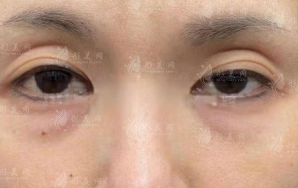 北京眼修复魏志香口碑咋样?分型修复+毫米精修技术解析