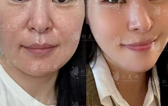 馒化脸能救吗?填充没效果+反弹真相全解析