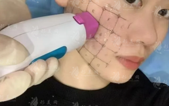 热玛吉和超声炮怎么选?松垂细纹对症攻略来了