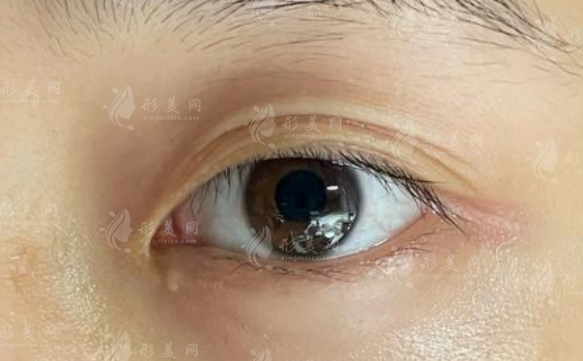 沈阳陈龙双眼皮修复靠谱吗?真实技术解析来了 沈阳陈龙双眼皮修复靠谱吗?真实技术解析来了