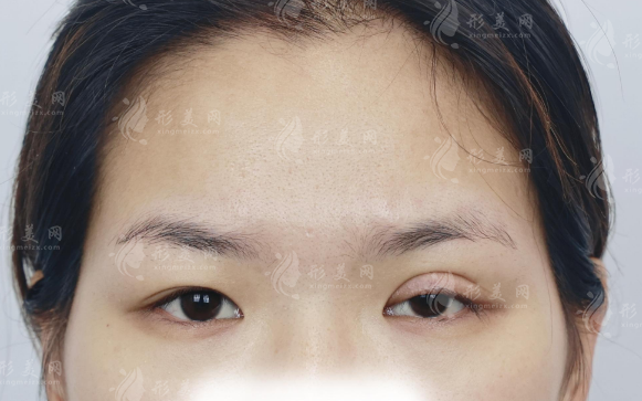 王维上睑下垂修复靠谱吗?技术解析+价格参考,一文看懂 王维上睑下垂修复靠谱吗?技术解析+价格参考,一文看懂