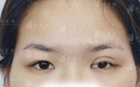 北京王恒上睑下垂修复口碑好吗?闭眼无痕技术适合多类人群 北京王恒上睑下垂修复口碑好吗?闭眼无痕技术适合多类人群