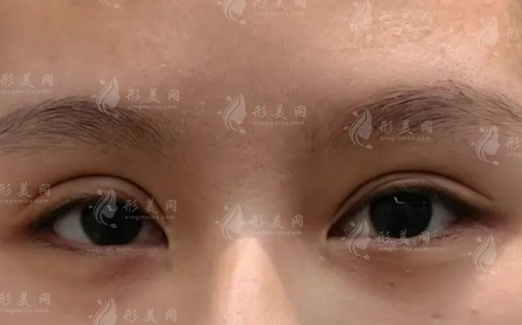 北京王恒修复双眼皮技术强吗?失败眼修复价格全揭秘