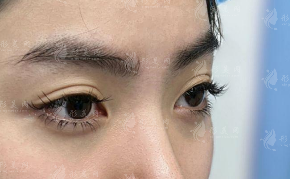 成都懿和唯美晏国富眉弓技术好吗?价格口碑与避坑指南全解析