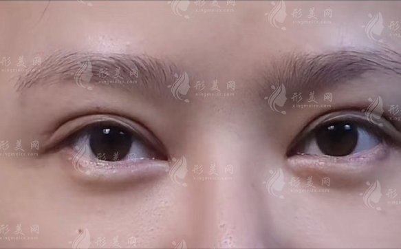 合肥双眼皮修复周瑜技术好吗?高难度眼修复价格口碑全揭秘