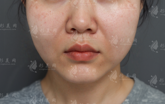 脸肿成发面馒头?填充过度的三大坑与馒化脸修复指南